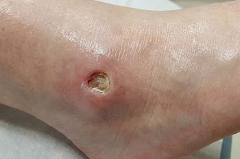 Arterial Ulcer