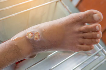 diabetic foot ulcers