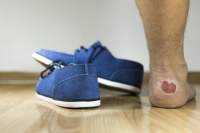 Causes and Care for Blisters on the Legs and Feet